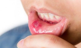 口腔溃疡新闻爆料,专家提醒关注口腔健康问题